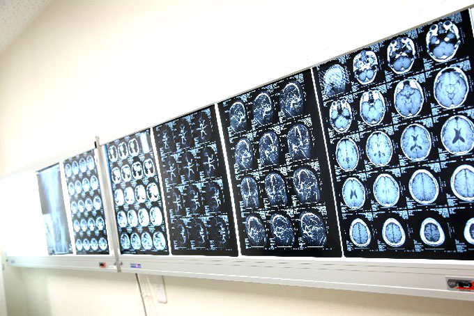 脳ドックも人間ドックも目的は一つ！脳ドックは脳動脈瘤など緊急性がある場合の確認検査。