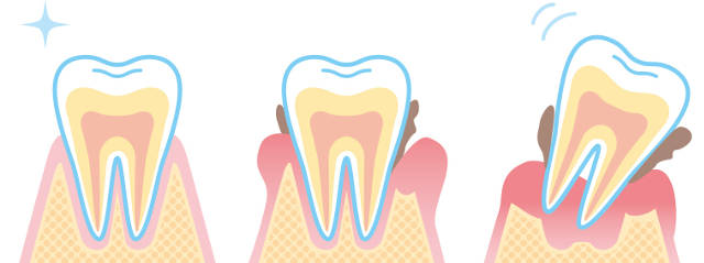 劇的で確実に虫歯や歯周病、歯槽膿漏を減らす方法とは？